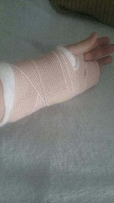 broken hand
